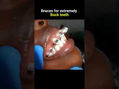 Braces for extremely buck teeth #braces #orthodontist #dentist #dental